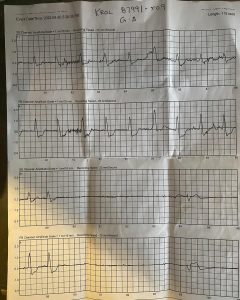 MATT KROL: actual EKG Strips